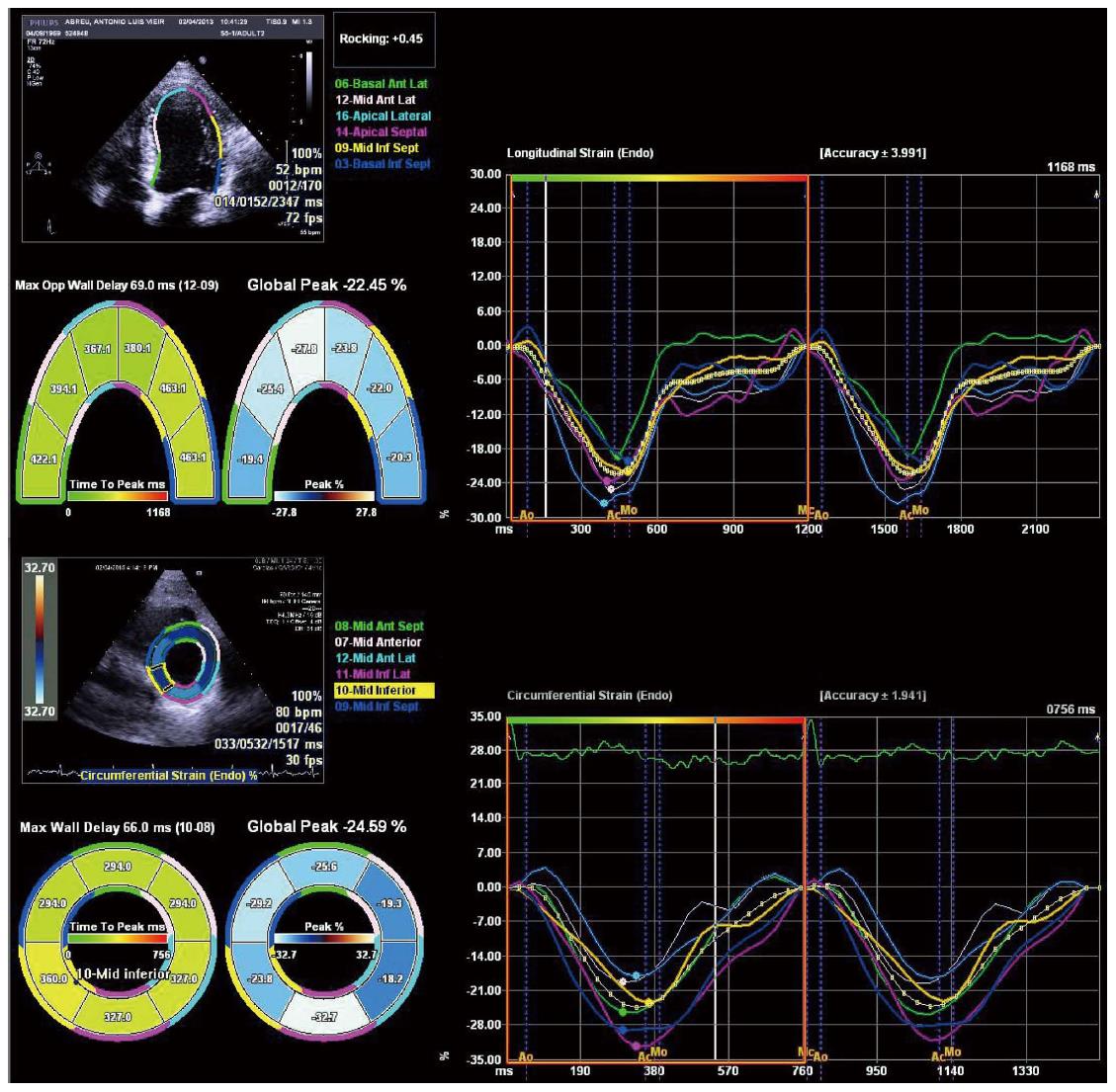 Frontiers  Association Between 2D- and 3D-Speckle-Tracking Longitudinal  Strain and Cardiovascular Magnetic Resonance Evidence of Diffuse Myocardial  Fibrosis in Heart Transplant Recipients