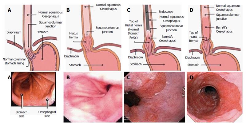 Evolving Management Of Metaplasia And Dysplasia In Barrett S Epithelium   WJG 22 10316 G002 