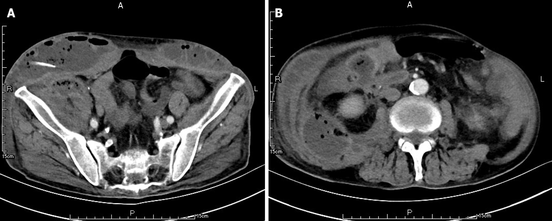 renal halo sign in acute pancreatitis
