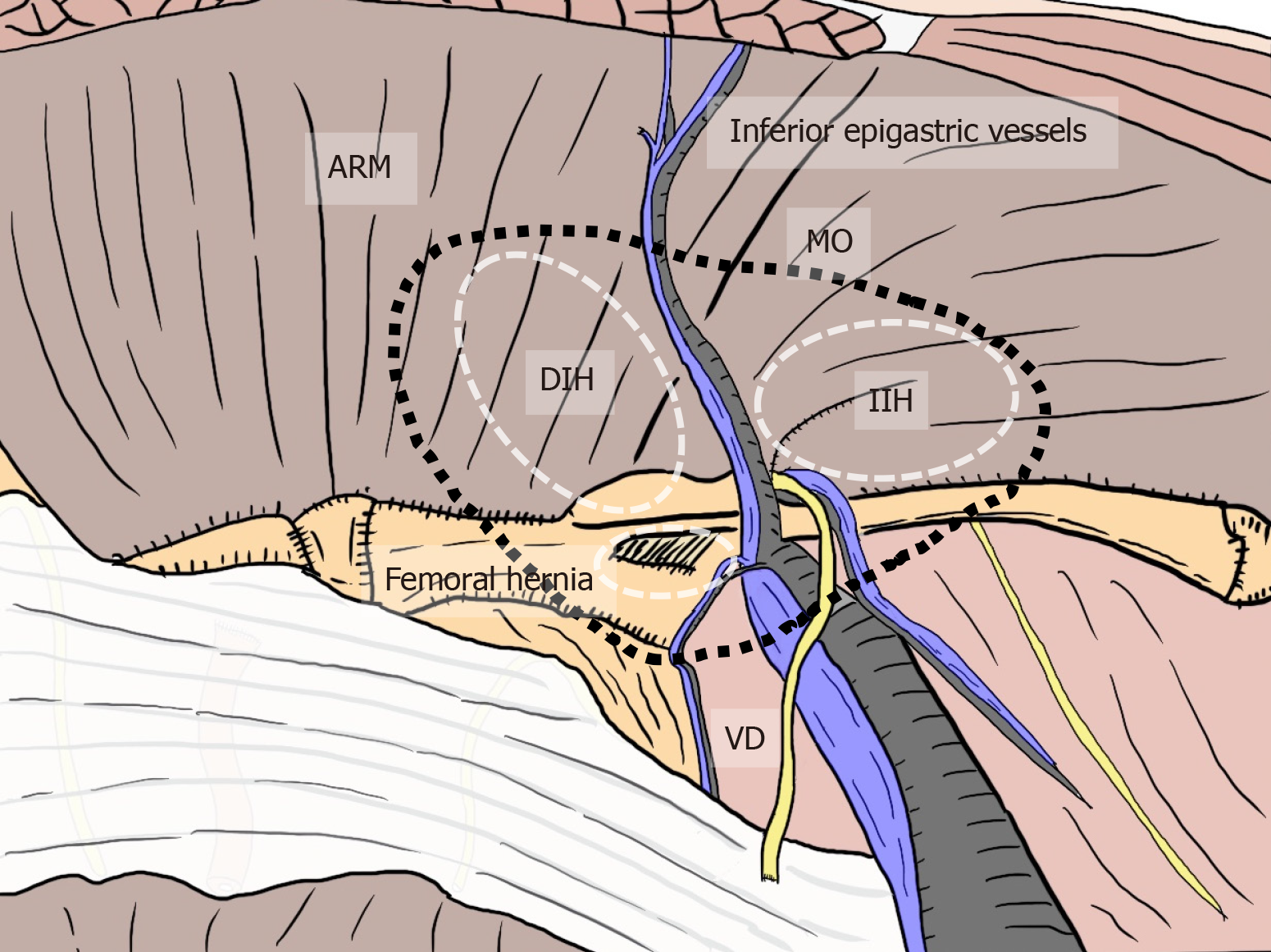 Direct Inguinal Hernia Anatomy