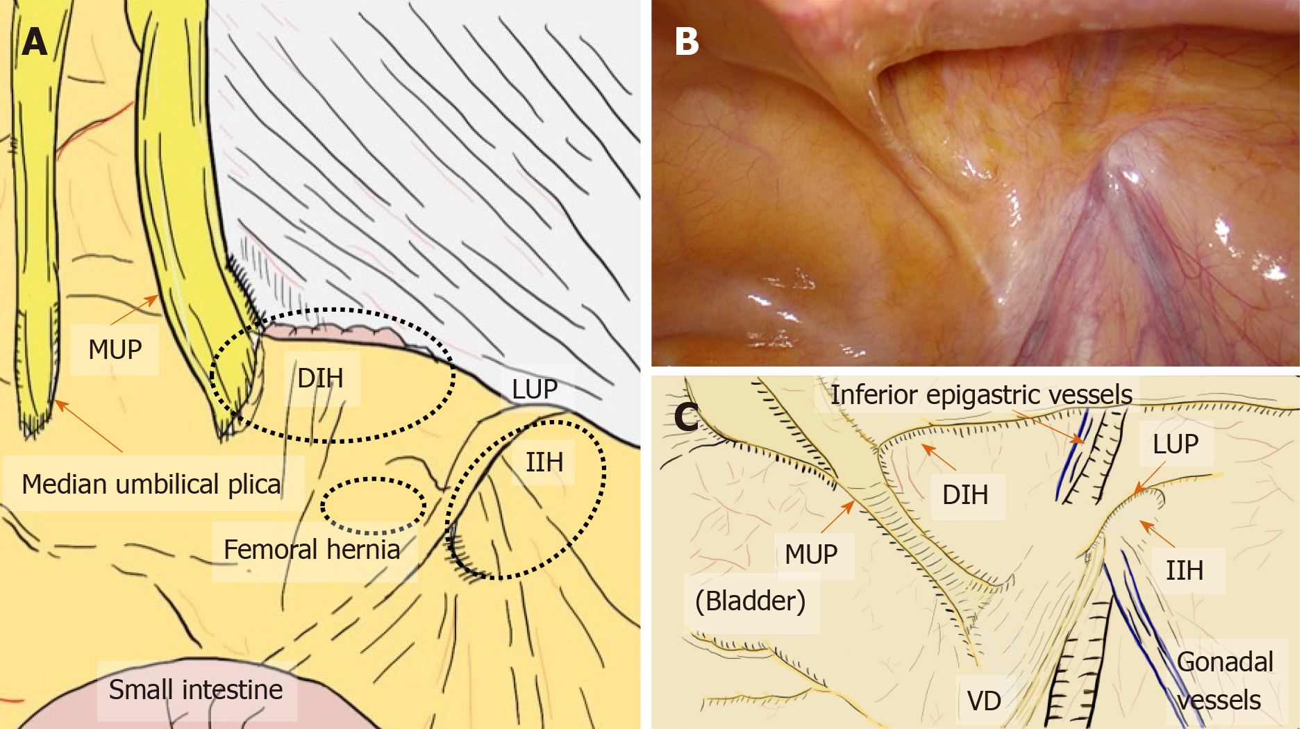 Laparoscopic inguinal hernia repair (TEP)