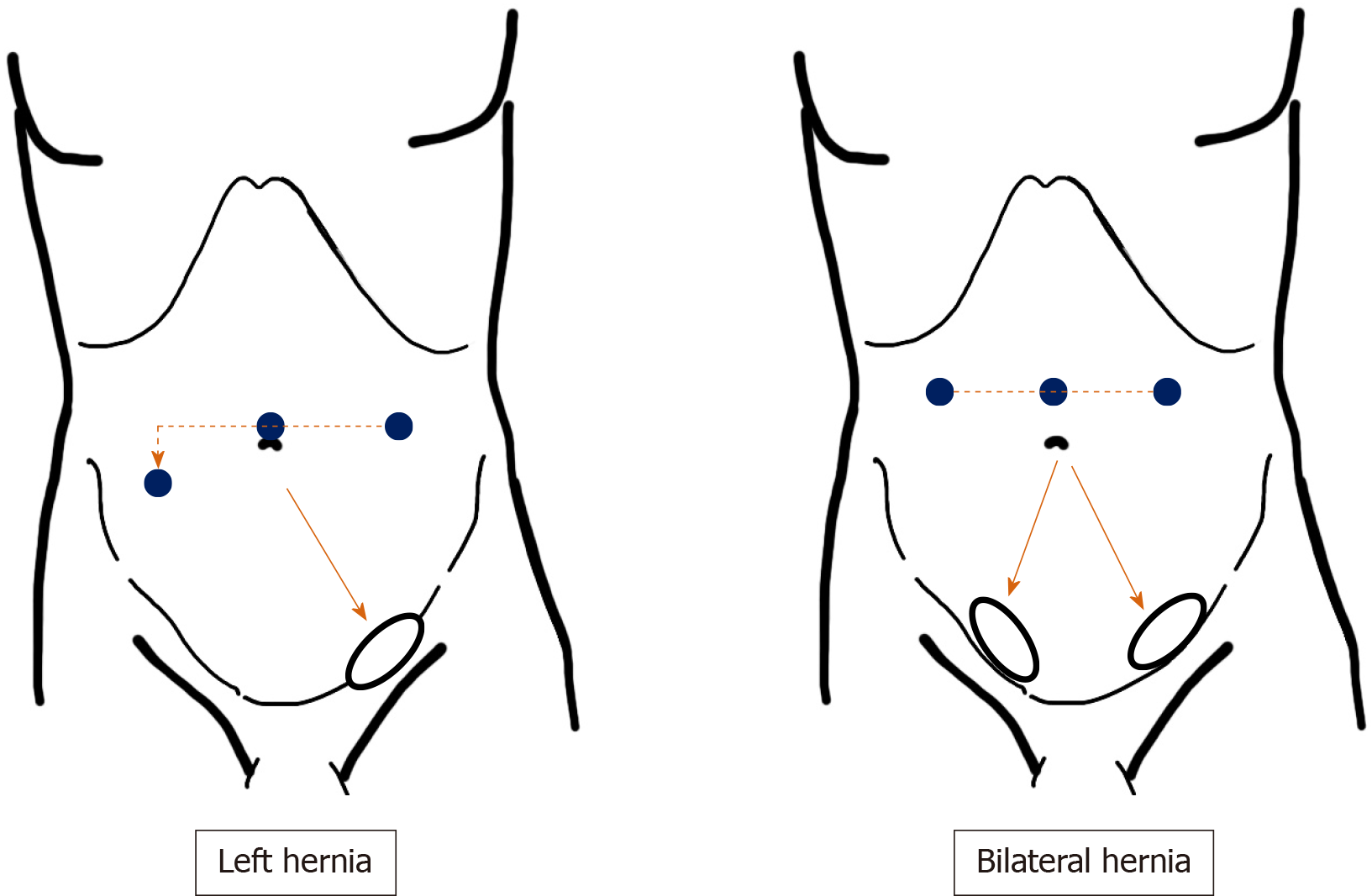 Femoral hernia repair – TIPP technique