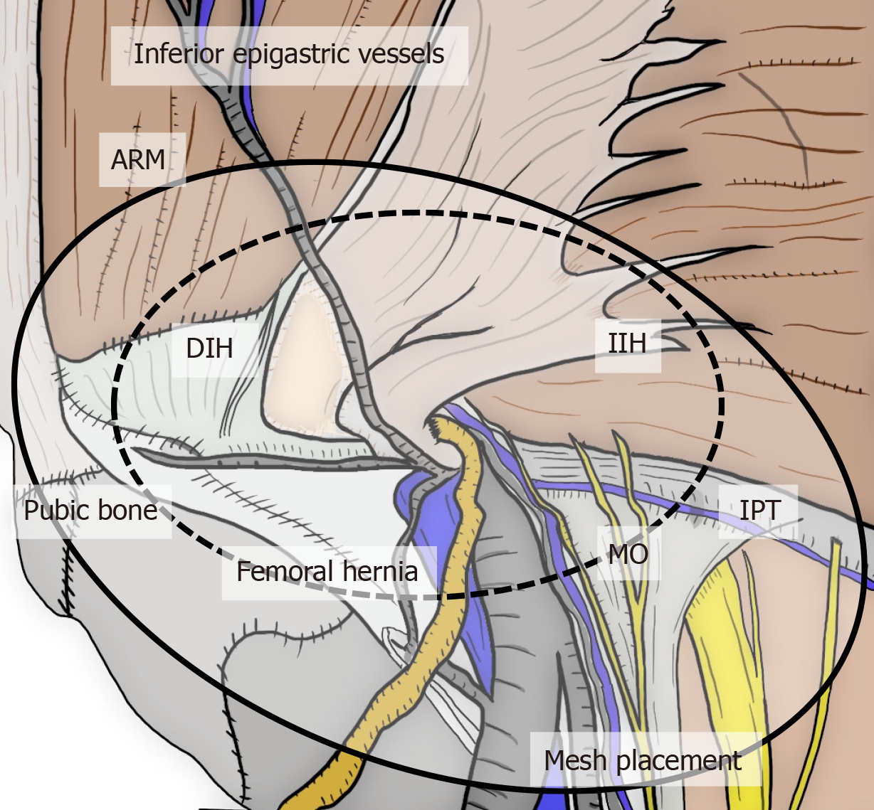 Perioperative management - Femoral hernia repair – TIPP technique