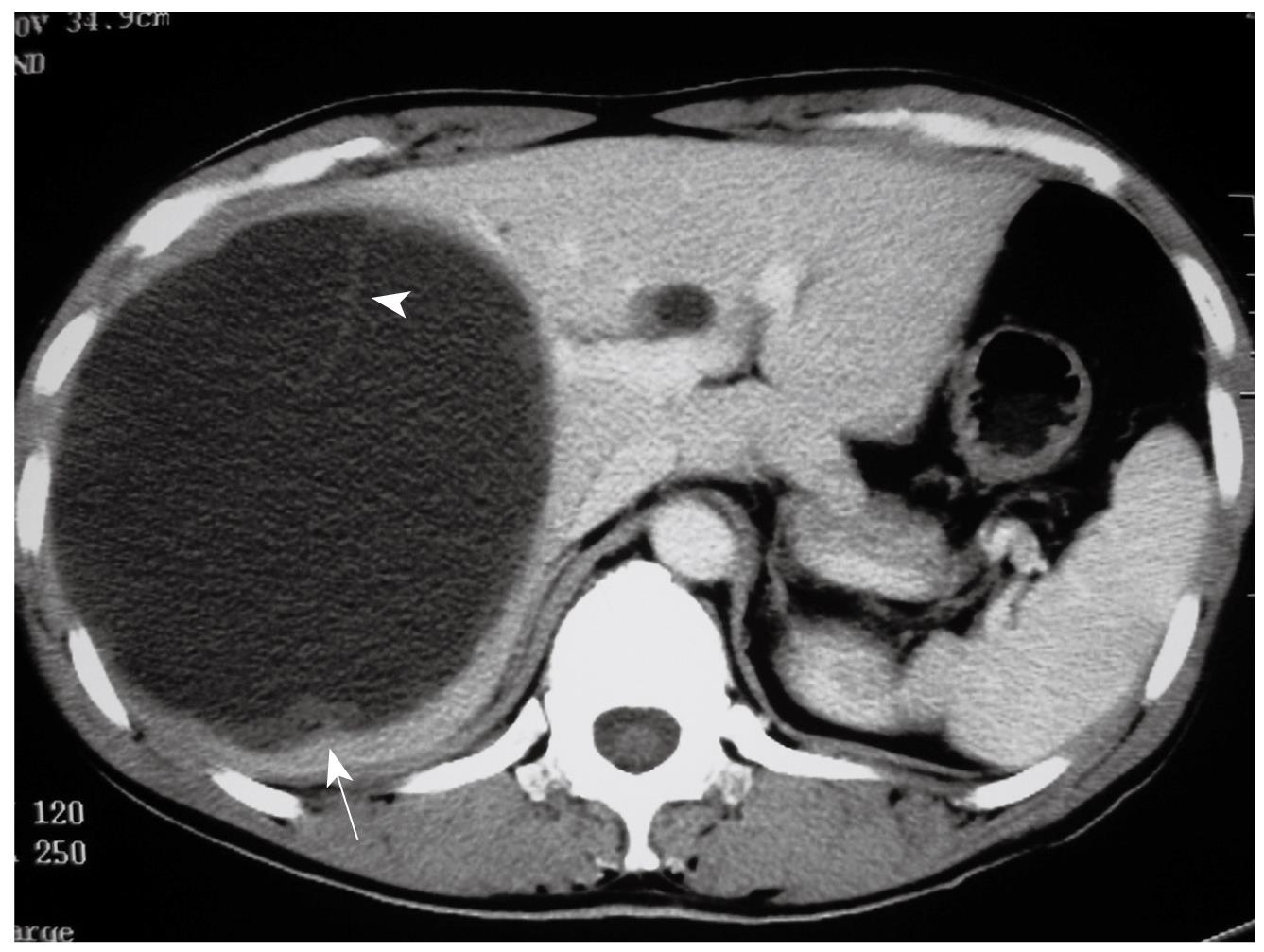 Liver Cyst CT Scan