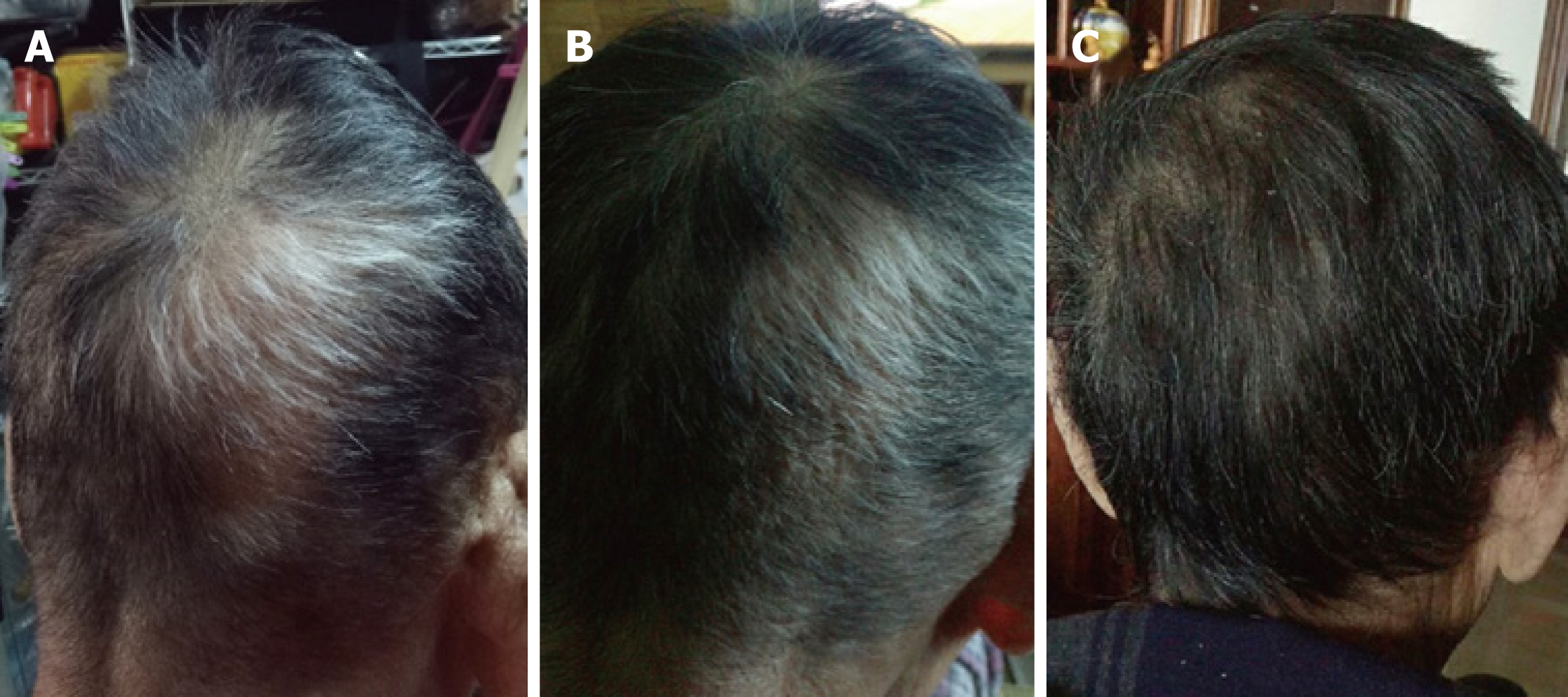 Hair regrowth following fecal microbiota transplantation in an elderly  patient with alopecia areata: A case report and review of the literature