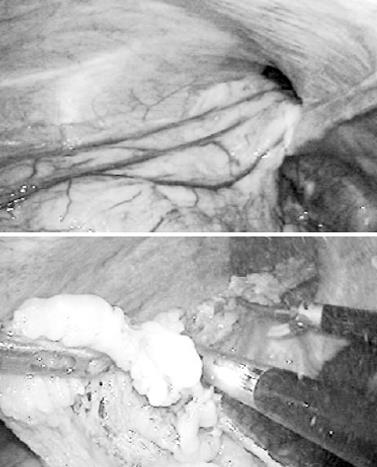 figure surgery inguinal case report omentum revealed intraoperative protrusion examination rectal performed laparoscopic cancer during into part