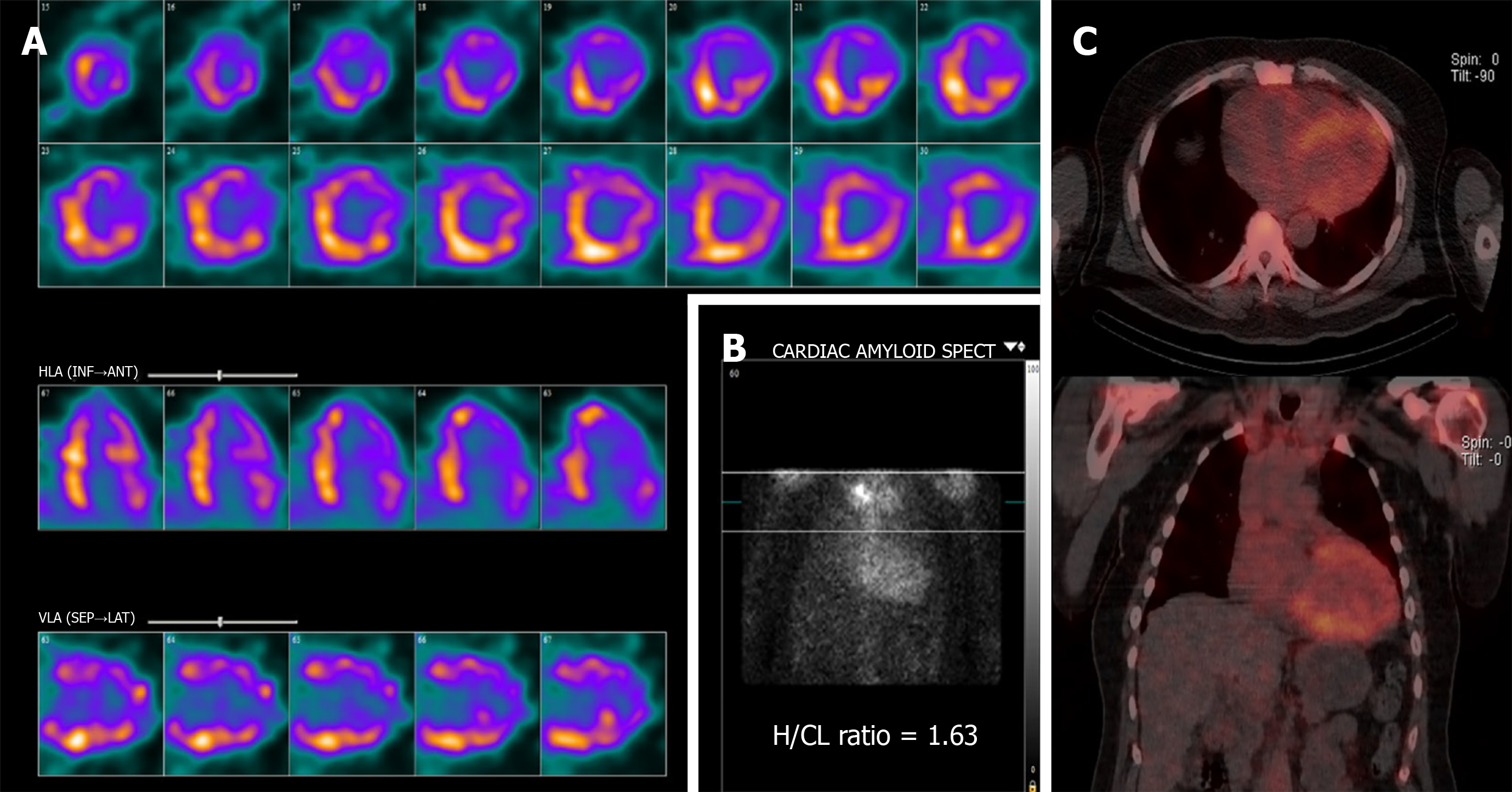 Global and Regional Variations in Transthyretin Cardiac Amyloidosis: A  Comparison of Longitudinal Strain and 99mTc-Pyrophosphate Imaging