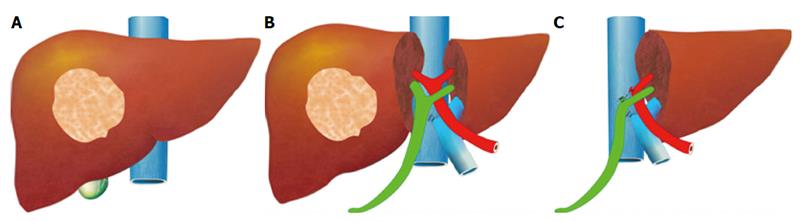 Resultado de imagem para Associating Liver Partition with Portal vein ligation for Staged hepatectomy