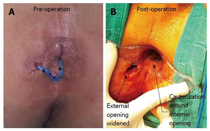 cauterization of granulation tissue