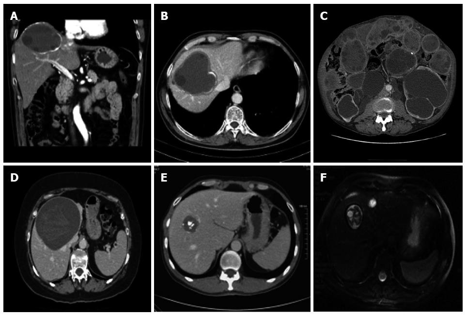 Echinococcosis Ct