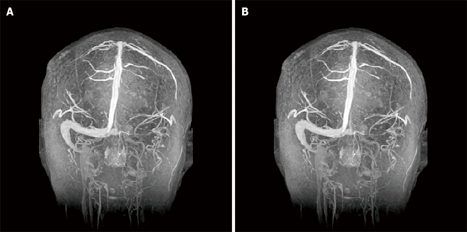 internal jugular vein brain