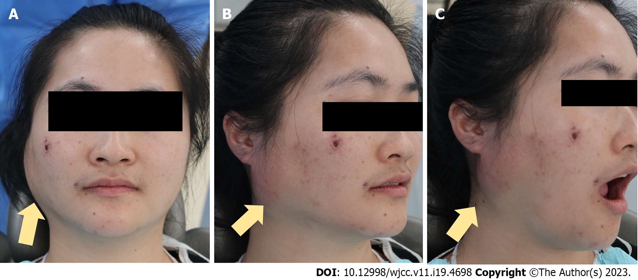 Investigation of the Electric Handpiece-related Pneumomediastinum and  Cervicofacial Subcutaneous Emphysema in Third Molar Surgery