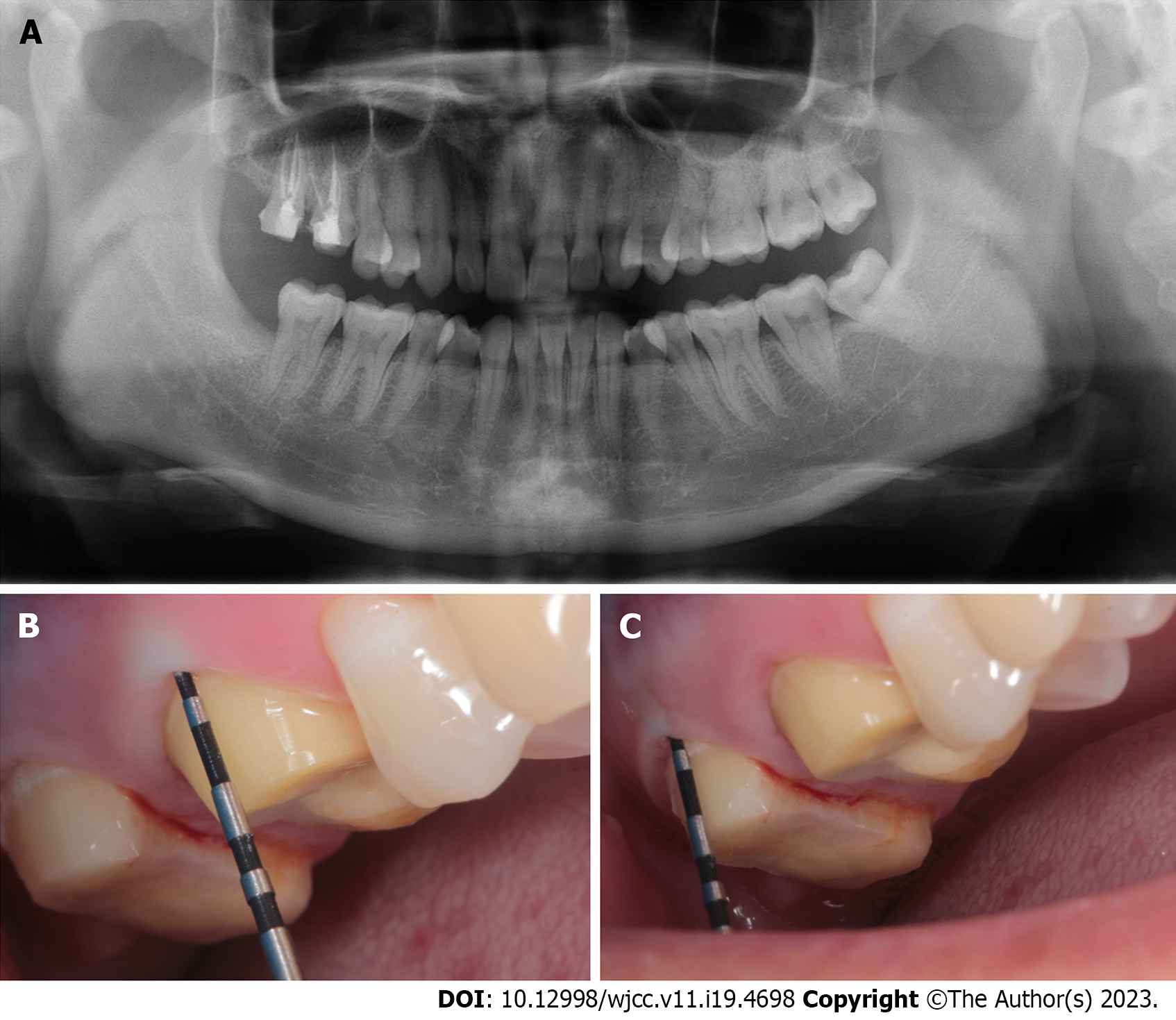 Gingival Sulcus Depth