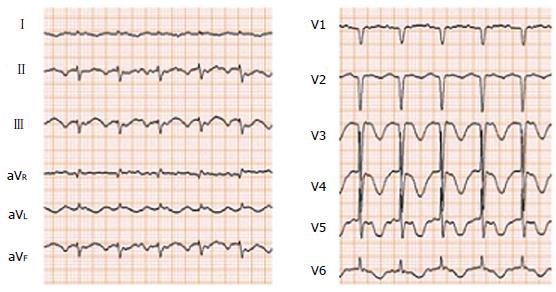 takotsubo cardiomyopathy symptoms