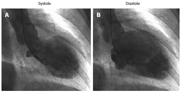 Familial apical dilated cardiomyopathy in a young man: a novel phenotype of  Takatsubo syndrome or a new entity altogether?