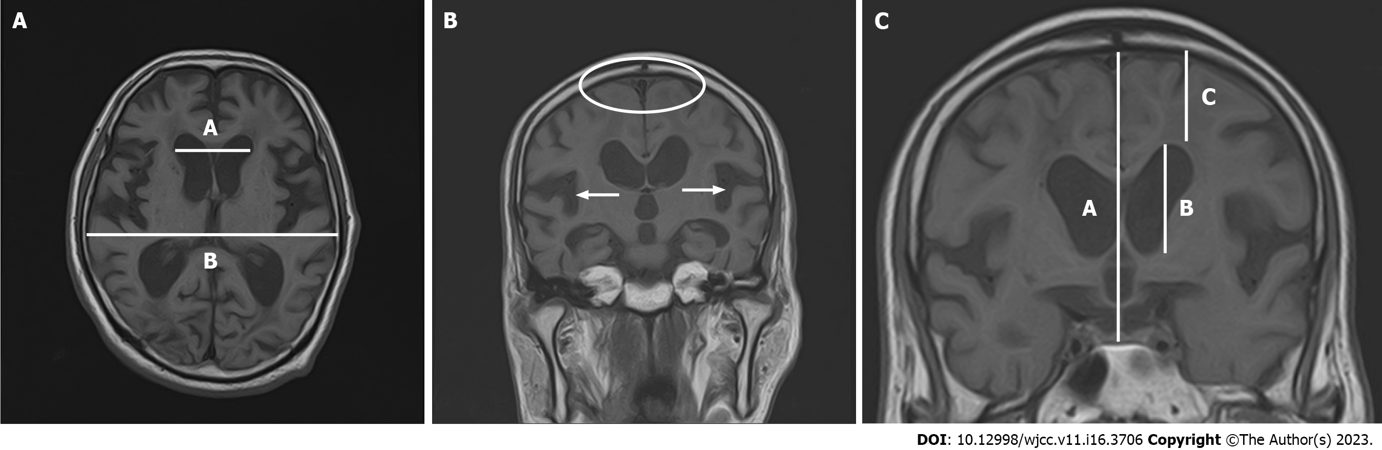 normal pressure hydrocephalus