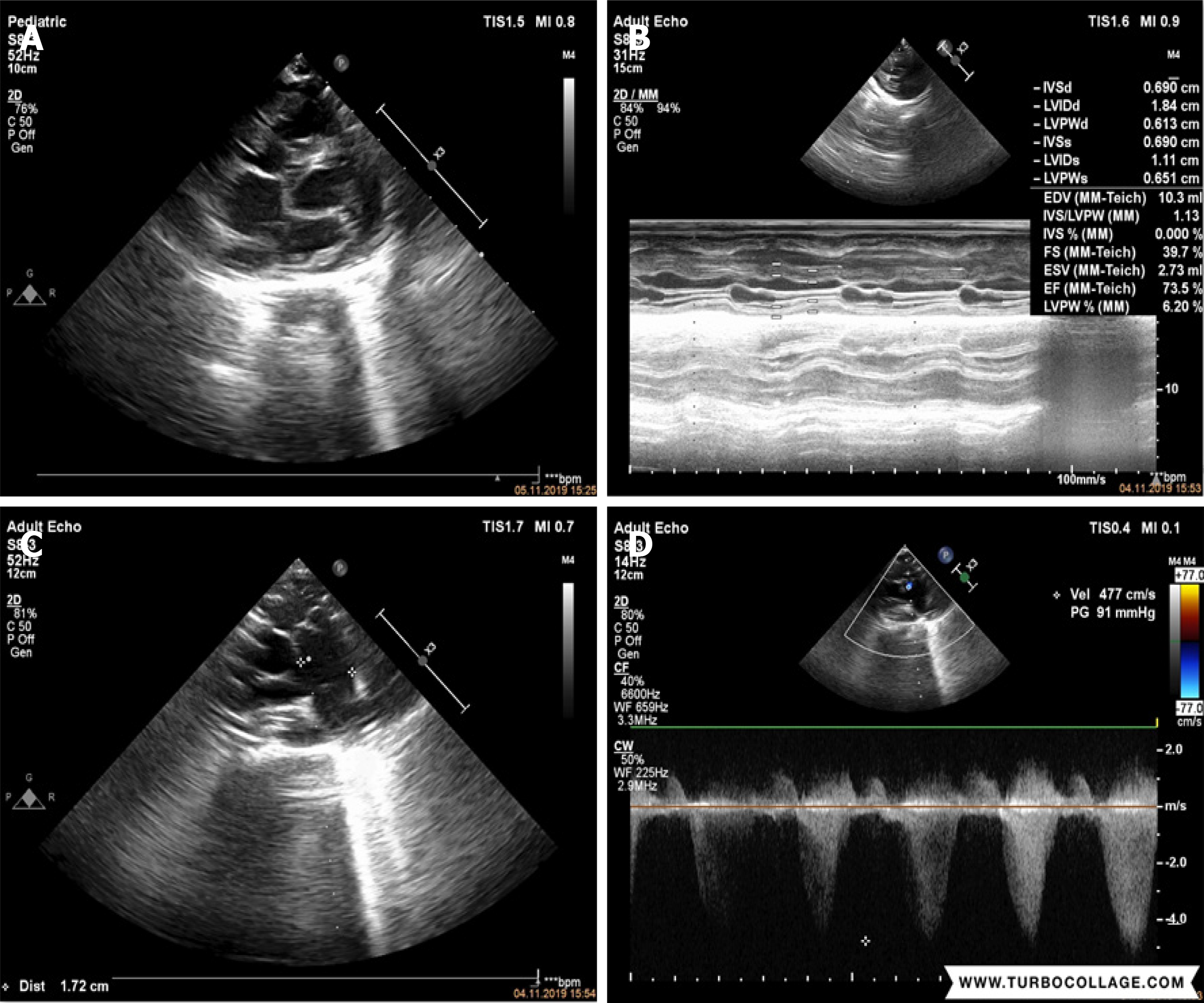 Anaesthesia Management in a Child with Rubinstein - Taybi Syndrome