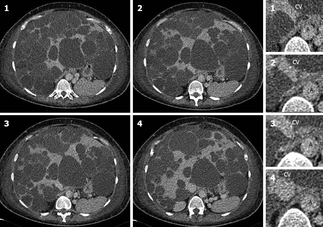 Fatal liver cyst rupture in polycystic liver disease complicated