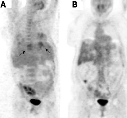 Complications arising in simple and polycystic liver cysts