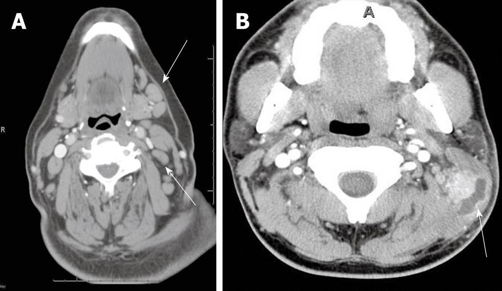 retropharyngeal abscess mri