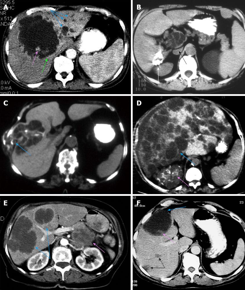 Fatal liver cyst rupture in polycystic liver disease complicated