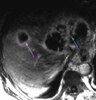 Fatal liver cyst rupture in polycystic liver disease complicated