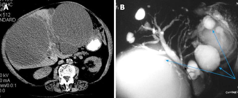 Fatal liver cyst rupture in polycystic liver disease complicated