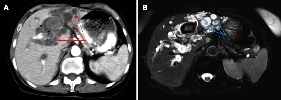 Fatal liver cyst rupture in polycystic liver disease complicated