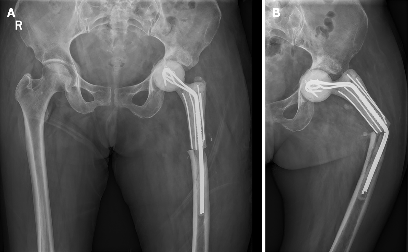 Cemented hip replacement improves quality of life for patients