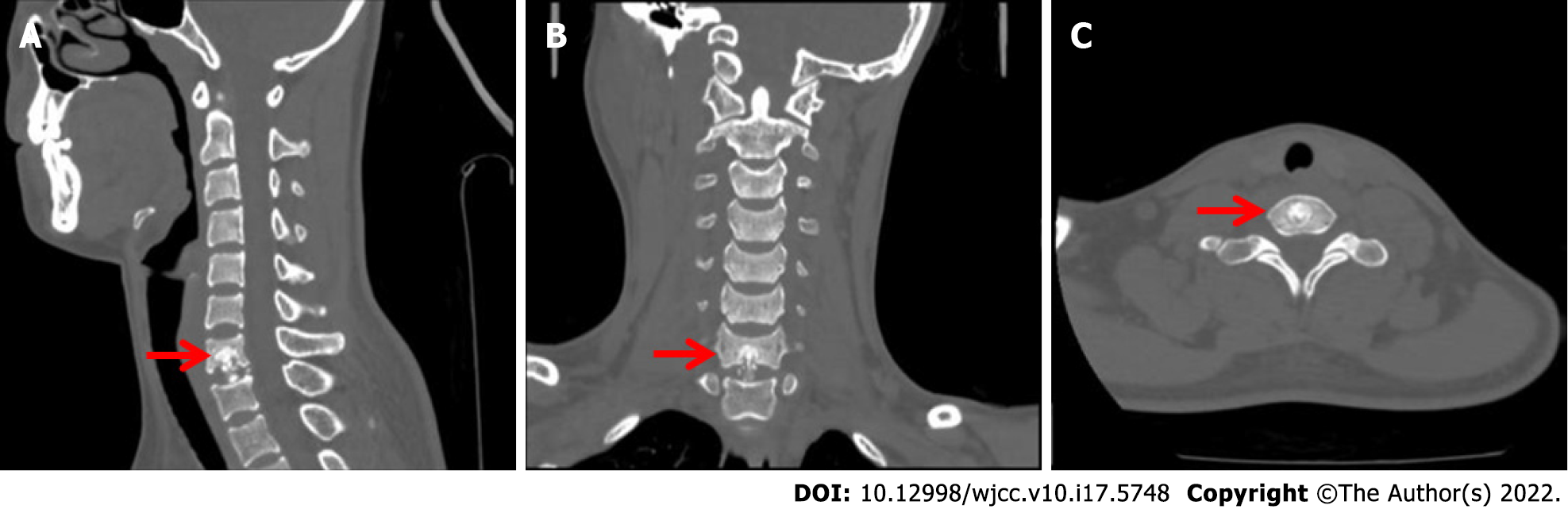 Chondromyxoid fibroma of the cervical spine: A case report