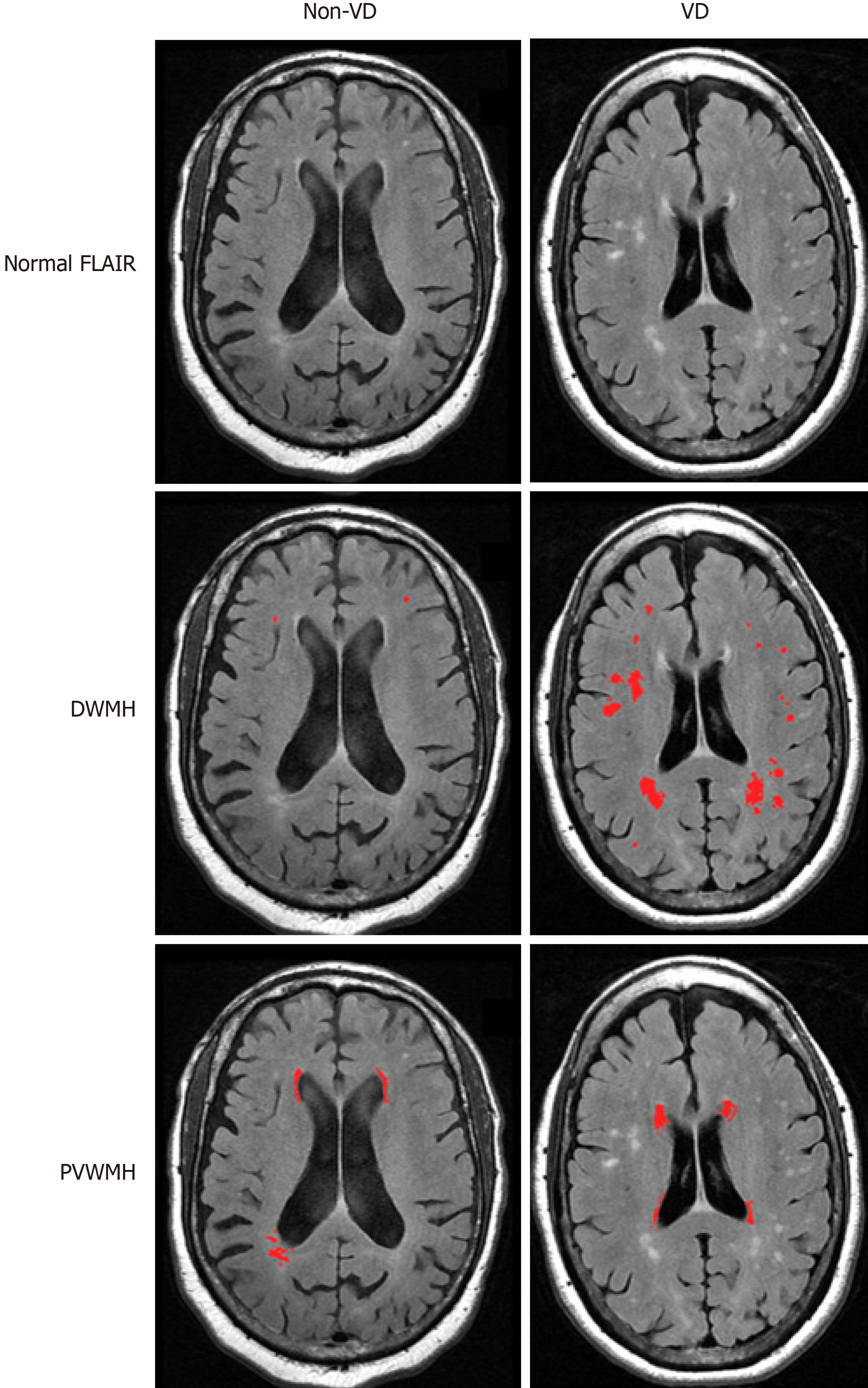 Микроангиопатия головного мозга fazekas. Перивентрикулярный лейкоареоз на кт. Fazekas 1-2. Лейкоареоз по Фазекас. Лейкоареоз Fazekas 1.