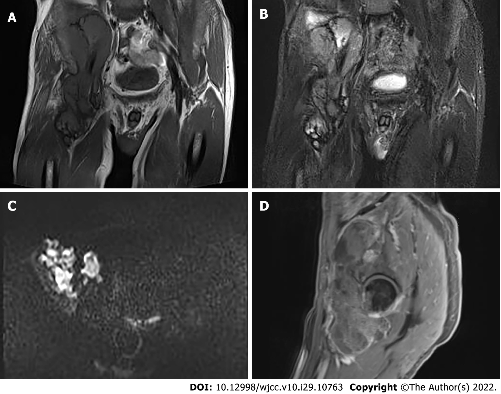 Malignant Giant Cell Tumors Of The Tendon Sheath Of The Right Hip A