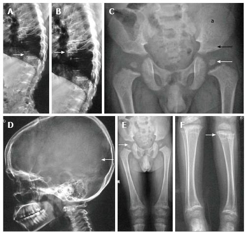 diastrophic dysplasia ultrasound