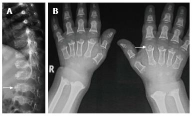 achondroplasia x ray vs normal