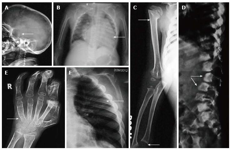 Skeletal dysplasias: A radiographic approach and review of common  non-lethal skeletal dysplasias