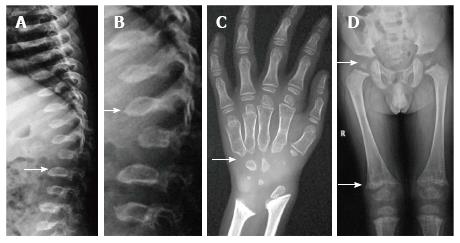 Pseudoachondroplasia Xray