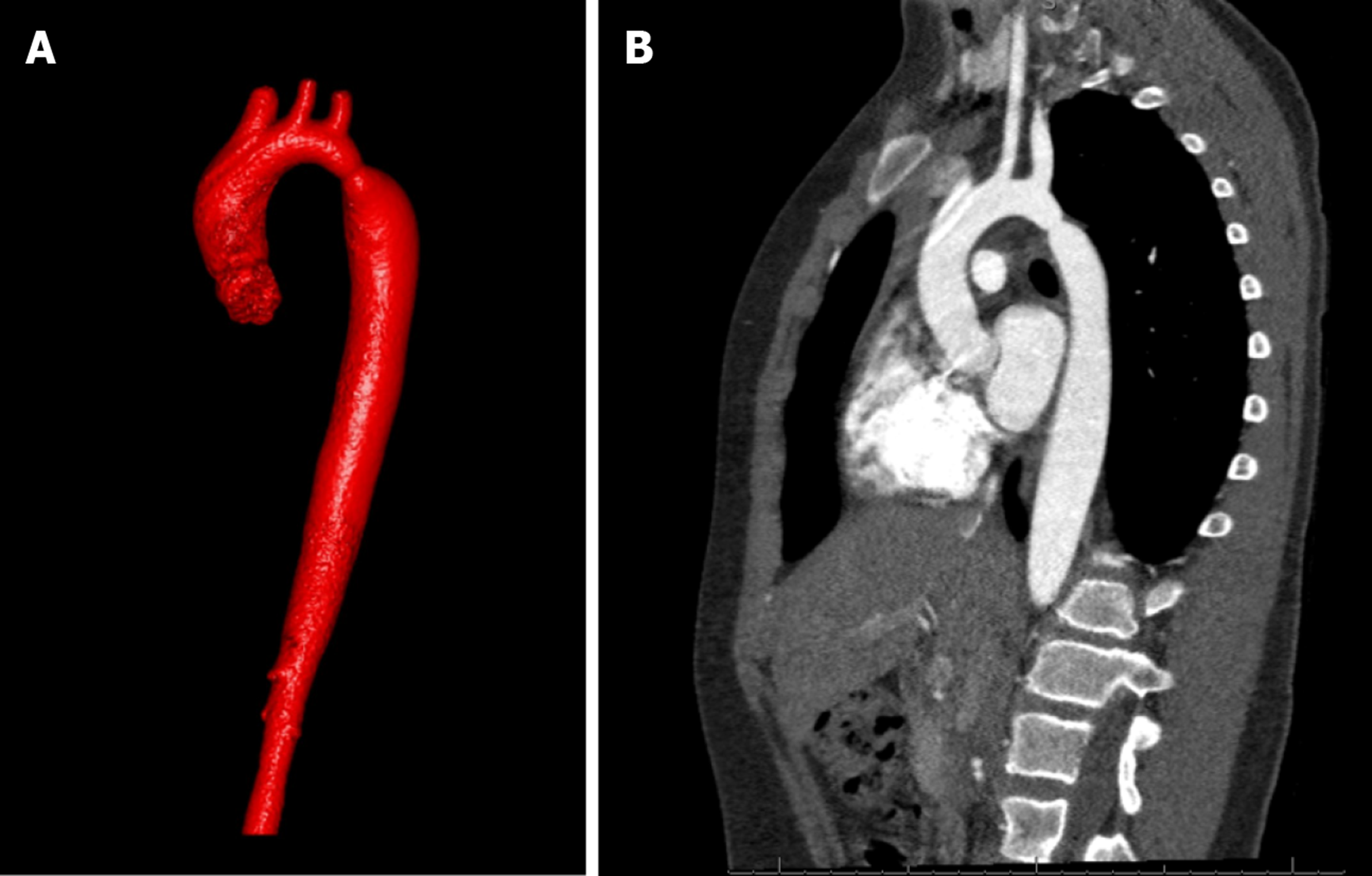 Management Of Adults With Coarctation Of Aorta
