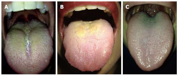 hairy tongue from chewing tobacco