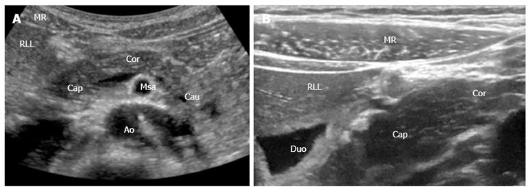 Ultrasonography in diagnosing chronic pancreatitis: New aspects