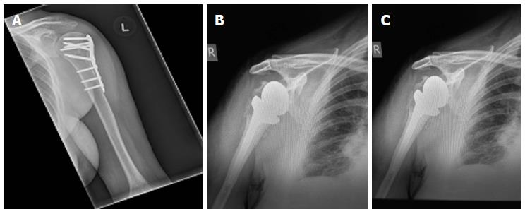 Management Of Proximal Humerus Fractures In Adults