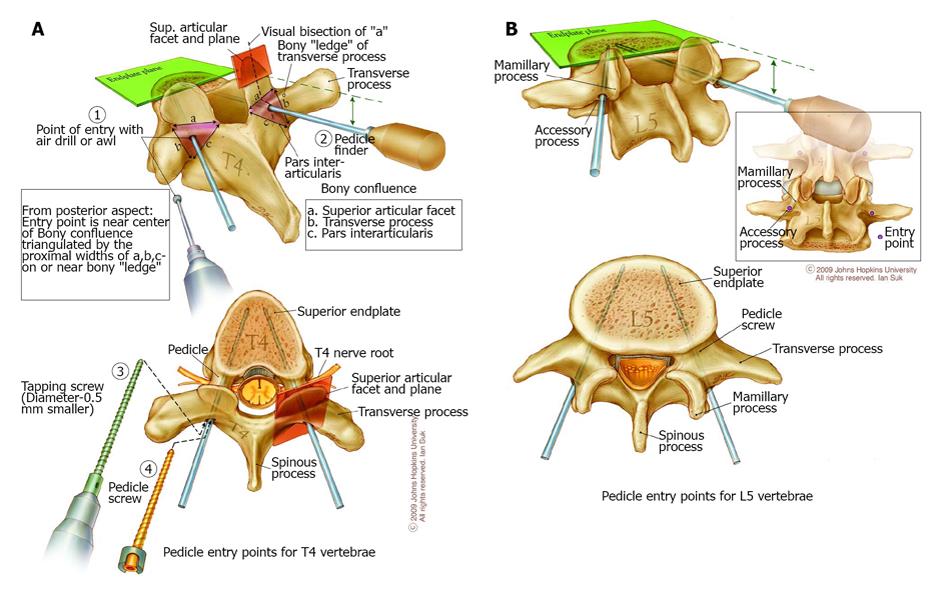 pedicle screw