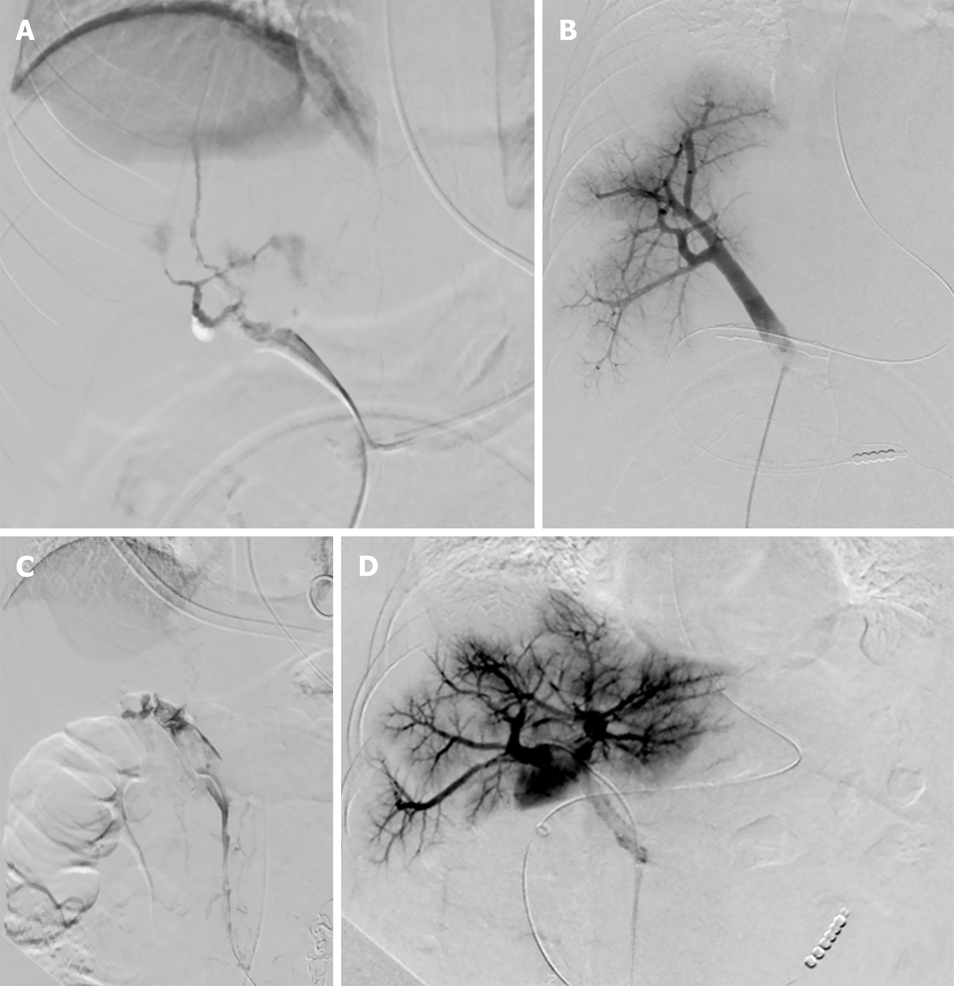 Transileocolic Endovascular Treatment By A Hybrid Approach For Severe