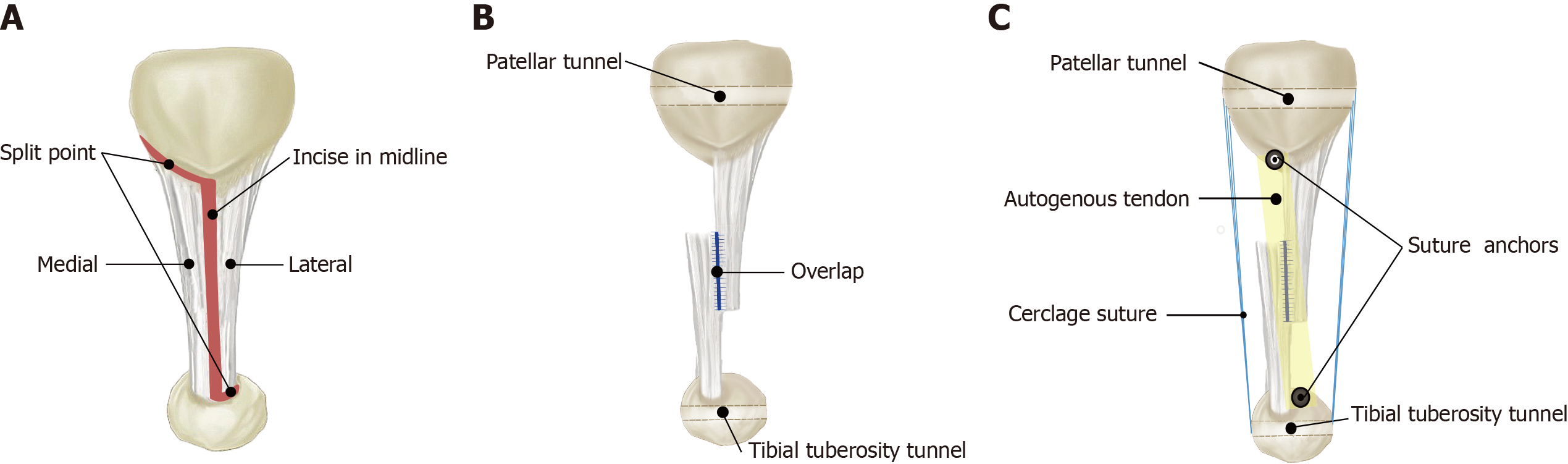 Autogenous iliotibial band enhancement combined with tendon