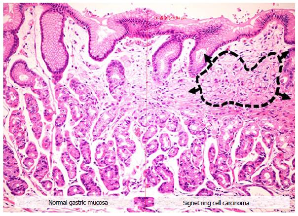 Figure 3 from Signet Ring Cell Carcinoma of Ampulla of Vater: Report of a  Rare Malignancy and Literature Review | Semantic Scholar