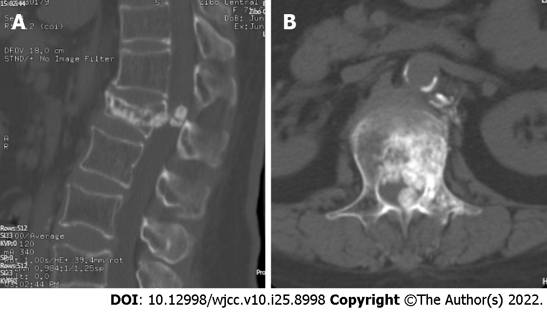 Delayed Complications Of Intradural Cement Leakage After Percutaneous