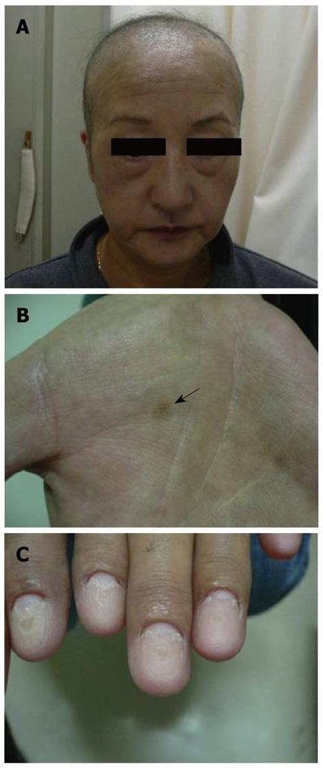 myelodysplastic syndrome skin