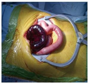 bowel obstruction small adhesive surgery adhesion band adhesions figure management caused single open