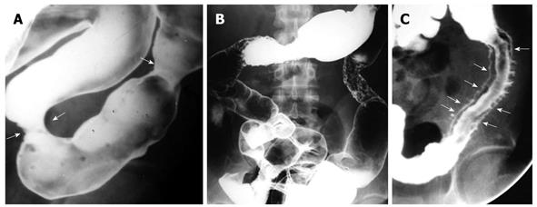 Crohn's Disease and Skip Lesions: What's the Significance?