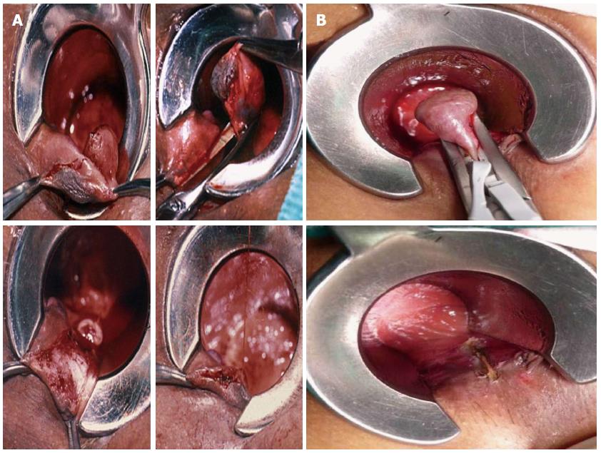 Treatment for external and internal Bleeding hemorrhoids