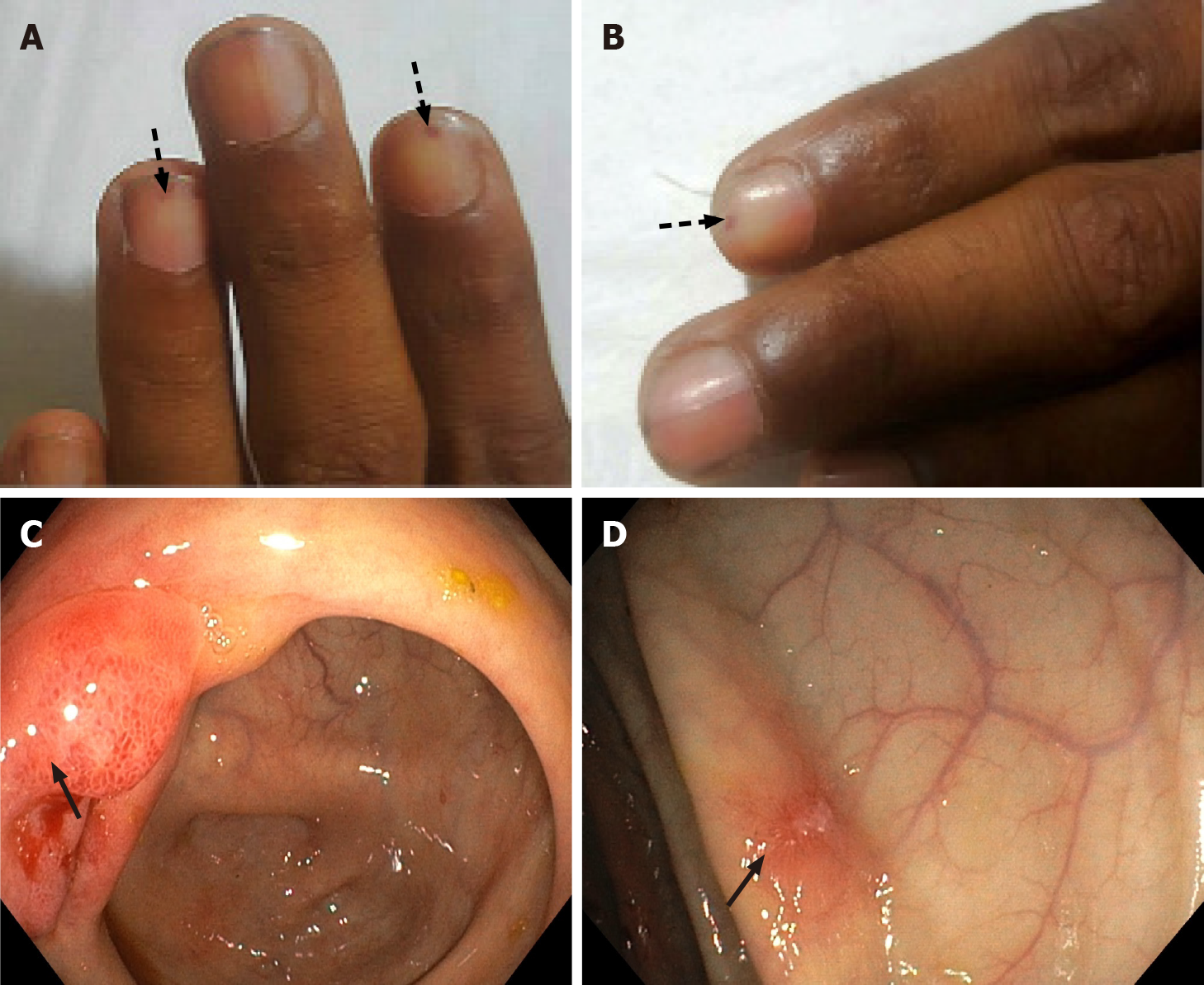 Nails in systemic disease | RCP Journals
